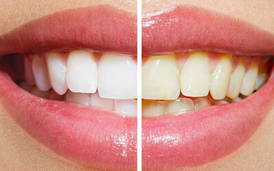 Getting the Most Out of Your Teeth Whitening Treatment