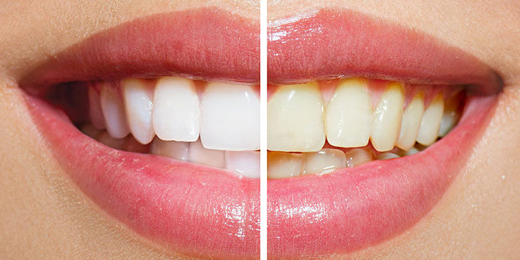 Getting the Most Out of Your Teeth Whitening Treatment