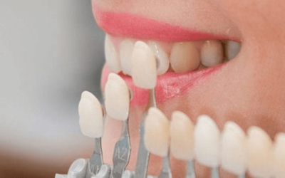 Five Reasons to Consider Dental Veneers